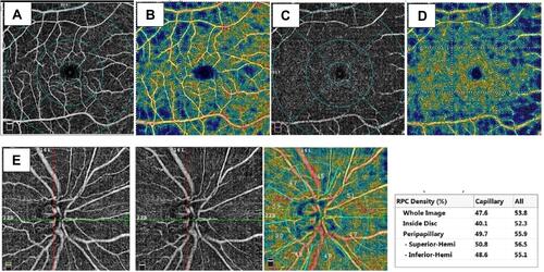 Figure 3 (A and B) Representative angiographic images of the right eye of case number 1 with AL±23.27mm (Group B), 6mm×6mm scan of the superficial plexus and density map, (C and D) of deep capillary plexus and its density map, (E) angiographic images of the optic disc 4.5×4.5mm scan.