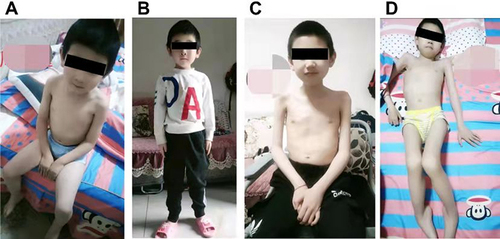 Figure 2 Clinical images of the proband III-15 (A and B) and his eldest brother (C and D) in pedigree 1.