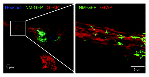 Figure 1. Confocal image of an astrocyte transduced with NM-GFP encoding lentivirus. The cells were treated with 1 µM recombinant NM fibrils (monomer equivalent) for 24 h and fixed 48 h post fibril addition. A net-like NM-GFP aggregate structure with very high fluorescence intensity was visible close to the nucleus (left). Higher magnification of the cell periphery showed further spindle-shaped NM-GFP (green) aggregates present throughout the cytoplasm (right). Nuclei were stained with Hoechst (blue) and GFAP with anti-GFAP antibody (red). (Scale bar = 5 µm).