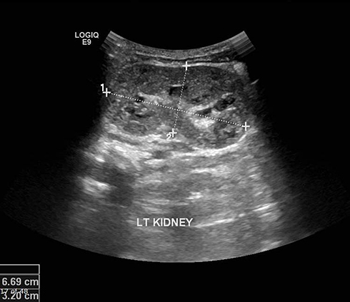 Figure 4 Left kidney (bulky: 6.6 x 2.2 cm) with multiple tiny cortical cysts during follow up.