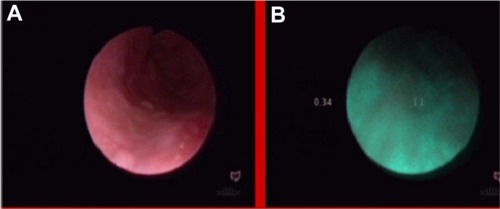 Figure 18 Glycogen acanthosis, in white light endoscopy (A) and autofluorescence (B) imaging.