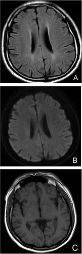 Figure 3 (A): FLAIR sequence of head MRI; (B): DWI sequence of head MRI; (C): T1 sequence of head MRI. Head MRI did not show meningeal enhancement.