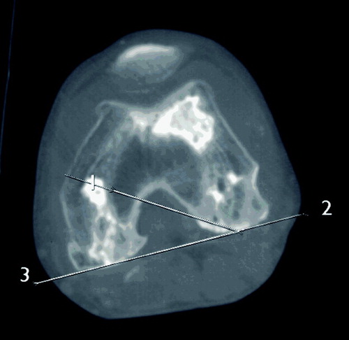 Figure 1. Definition of TEA (2) and PKA (1) on an axial CT scan of the distal femur.