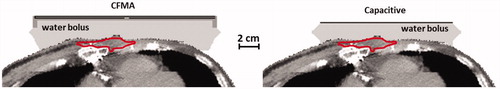 Figure 2. CT scan with the position of the modelled CFMA and capacitive antennas, for a recurrent breast cancer patient model. The contour represents the target delineation.