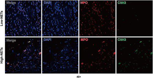 Figure 1 Representative images of immunofluorescence staining of low NET density (upper panel) and high NET density (lower panel) in LARC samples without neoadjuvant therapy. Magnification 40×. DAPI, Blue; MPO, Red; CitH3, Green.