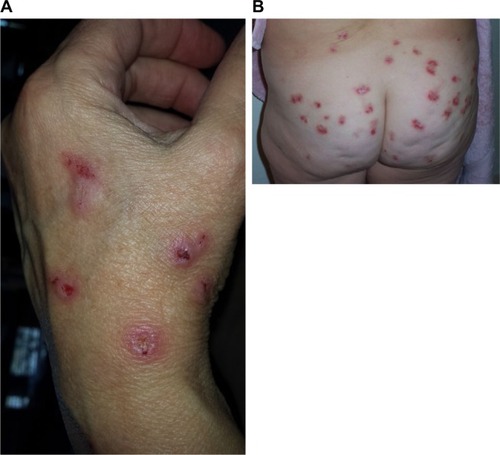 Figure 1 (A) Skin lesions on the hand of a Morgellons disease patient. (B) Skin lesions on the buttocks of a Morgellons disease patient.