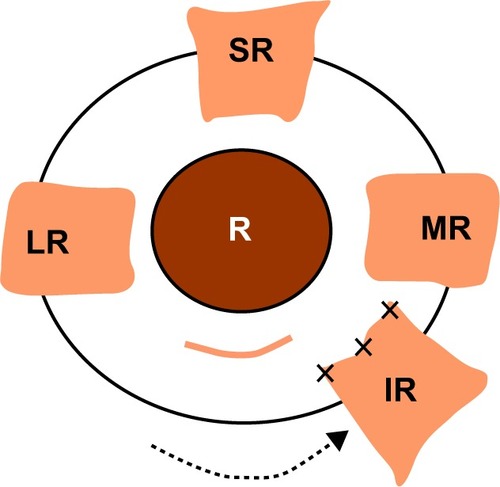 Figure 1 Surgical procedure of inferior rectus (IR) nasal transposition. IR was recessed and transposed nasally along with the spiral of Tillaux in the case of vertical deviation and excyclodeviation.