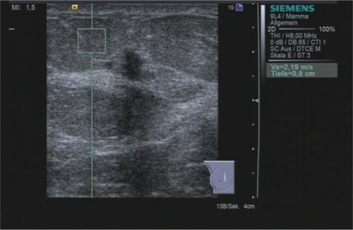 Figure 2 ARFI VTTQ of the adjacent adipose tissue. The shear wave velocity is 2.19 m/s.