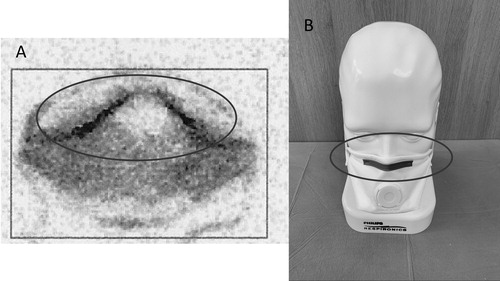 Figure 9. Increased radioactivity is seen around the upper edge of the respirator indicating leak flow in this area (A: scintigraphic image of the mounted mask (B)).