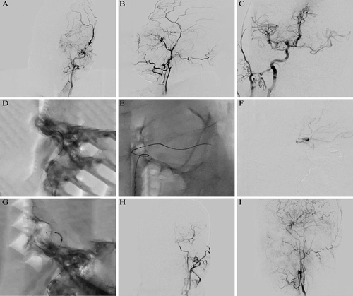 Figure 1 Representative case. Digital subtraction angiography showed occlusion of the left internal carotid artery with a conical stump (A and B). Digital subtraction angiography indicates the opening of anterior communicating artery (C). Microwire and microcatheter passed through the occlusive segment (D). Microwire and microcatheter reach M1 segment of left middle cerebral artery (MCA) (E). Microcatheter angiography was used to verify that the tip of the microcatheter was located in the real distal cavity (F). Balloon dilation procedure (G). Digital subtraction angiography indicated the left internal carotid artery was successfully recanalized, achieving a TICI grade of 3 (H–I).