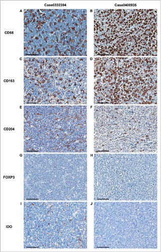 Figure 1. Representative images from the automated enumeration of tumor-infiltrating CD68+, CD163+, CD204+, FOXP3+, and IDO+ cells. Representative images of immune cells from two patients with primary CNS-DLBCL are demonstrated. CD68, CD163, and CD204 were expressed in a granular cytoplasmic pattern by macrophages. FOXP3 showed a nuclear pattern in small lymphoid cells. IDO was expressed in a granular cytoplasmic pattern by suspected macrophages, dendritic cells, small plasmacytoid dendritic cells, and vascular endothelial cells. Images were captured by virtual microscopy and submitted to an image analyzer, which delineated the positive cells by thin black lines, as seen in (A−F), (I) and (J). In the first case, the counts of CD68+ cells (A), CD163+ cells (C), and CD204+ cells (E) were 134, 115, and 115, respectively, per unit area (0.28 mm2). The count of FOXP3+ cells was 1 per unit area (0.28 mm2) (G). The count of IDO+ cells was 75 per unit area (0.28 mm2) (I). In the second case, the counts of CD68+ cells (B), CD163+ cells (D), and CD204+ cells were 294, 257, and 57, respectively, per unit area (0.28 mm2). The count of FOXP3+ cells in this case was 11 per unit area (0.28 mm2) (H). No IDO+ cell was observed in this case (J). (Scale bar, 100 μm, in all images).