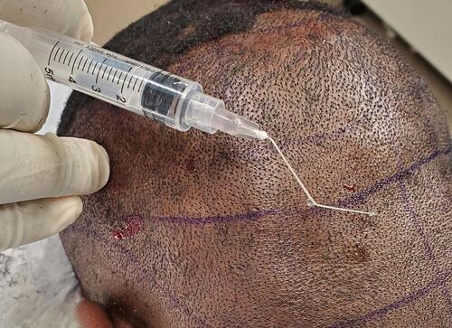 Figure 4 Example of thick/firm scalp. Patient 4 male patients of African descent. Left posterior oblique view showing thick firm scalp manifested by difficulty in penetrating scalp with a 27-gauge hypodermic needle that is bent during anesthesia injection.