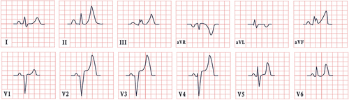 Figure 8 ECG features in hyperkalemia, revealing sinus rhythm, normal cardiac axis, prominent peaked T waves in leads II, III, aVF, V2-V6 and a widened QRS complex.