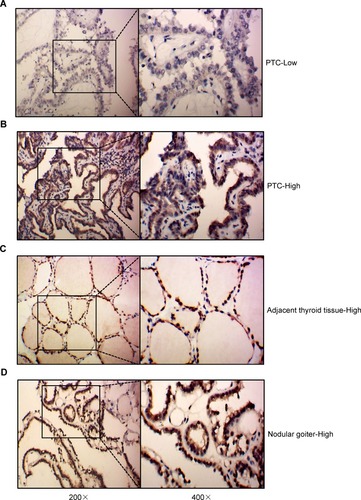 Figure 1 IHC results of the expression of JAZF1 in PTC, adjacent thyroid tissues and nodular goitre. (A and B) High expression and low expression of JAZF1 immunohistochemistry in PTC. (C) Typical representation of JAZF1 immunohistochemistry results in adjacent thyroid tissues. (D) Typical representation of JAZF1 immunohistochemistry results in nodular goitre. JAZF1 is mainly localized in the cytoplasm and nucleus. The left sides represent 200× amplification, the right sides represent 400× amplification.