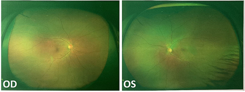 Figure 1 Fundus examinations showed clear boundaries and normal blood vessels in the optic disc, with no apparent retinal abnormality. OS, left eye; OD, right eye.