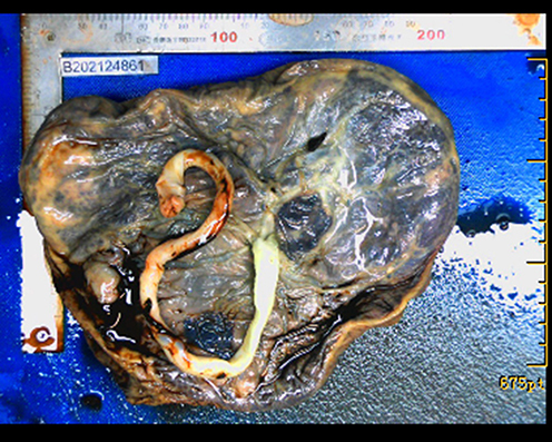 Figure 4 Image of the placenta. The placenta was approximately 20×18 cm in size and 450 g in weight, with large grayish-yellow infarcts.