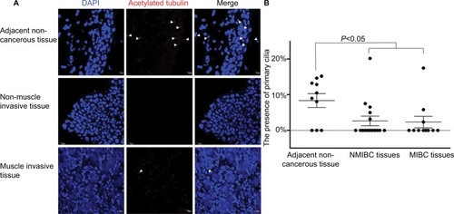 Figure 1 PC were reduced in BLCA.Notes: (A) Confocal immunofluorescence for the ciliary markers acetylated tubulin in red and DAPI in blue in adjacent non-cancerous, NMIBC and MIBC tissues. Cilia were easily observed in the mucosae of adjacent non-cancerous tissues. (B) The presence of PC in the adjacent non-cancerous, NMIBC and MIBC tissue samples. There was a statistical difference in the presence of PC between cancerous and adjacent non-cancerous tissue samples (P<0.05). Arrows indicate PC. Scale bar, 10 µm.Abbreviations: BLCA, bladder cancer; DAPI, 4′,6-diamidino-2-phenylindole; MIBC, muscle invasive bladder cancer; NMIBC, non-muscle invasive bladder cancer; PC, primary cilia.