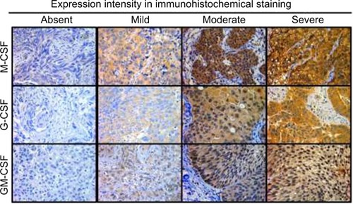 Figure 1 Expression of M-CSF, G-CSF, and GM-CSF in bladder cancer cells using immunohistochemistry. We evaluated M-CSF, G-CSF, and GM-CSF expression in treatment-naïve bladder cancer cells. Staining intensities were classified as absent (0), mild (1), moderate (2), and severe (3).