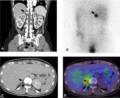 Figure 1 Illustrative example of adrenal images. (A) A 2.7 cm-sized mass of right adrenal gland (arrow) on adrenal CT scan in a 54-year-old female with hypokalemia and hypertension; (B) hot uptake (arrow) on 96-hour posterior image of NP-59 scintigraphy corresponding to (A). (C) Remaining right adrenal mass (arrow) on adrenal CT scan after left adrenalectomy in a 31-year-old female with bilateral adrenal mass. (D) Hot uptake (arrow) image of NP-59 scintigraphy with SPECT/CT which is a consistent lesion in (C).