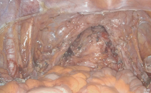 Figure 7. Postoperative laparoscopic view of pelvis – case 3.