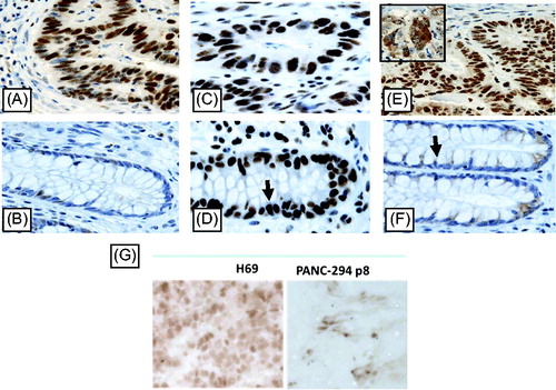 Figure 3. IHC staining of DNA methyltransferase 1, 3A and 3B protein in colorectal cancer (CRC) patients and DNMT1 in two 5 µm xenograft sections (G), selected for high and low DNMT1 mRNA expression. Positive immunoreactivity for DNMT1, 3A and 3B was found in CRC tissue (A, C, E) and corresponding normal tissue (B, D, F). Unlike DNMT3B that is present in the cytosol and nuclei (E insert), DNMT1 and DNMT3A are mainly well distributed only in the cytoplasm of tumour cells. DAB staining shows DNMT1 expression in brown. Pictures were taken with 40x lens magnification.