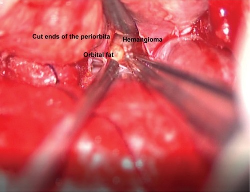 Figure 8 Intraoperative image showing the prolapsing orbital fat and the hemangioma within the cut ends of the periorbita.