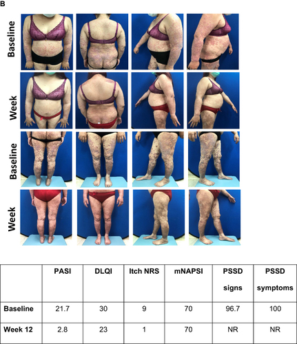 Figure 4 Visual treatment effects of GUS at Week 12. (A) Male aged 38 from Taiwan; psoriasis for 11.4 years, bio-naïve, previous systemic conventional therapy, disease duration 12 years, no PsA, overweight, dyslipidemia and hypertension. Initiated GUS as per label at baseline. (B) Female aged 45 from Taiwan; psoriasis for 13 years, bio-experienced, previous systemic conventional therapy, disease duration 13 years, PsA. Switched to GUS as per label at baseline.