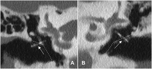 Figure 1. HRCT scan, coronal view Case 1 (A) and Case 4 (B) showing right and left middle ear respectively with luxated piston indicated by white arrows. A: loop is positioned lateral from TM; disconnection from the stapes foot plate. B: loop protruding through the TM, and absence of connection with the stapes foot plate.