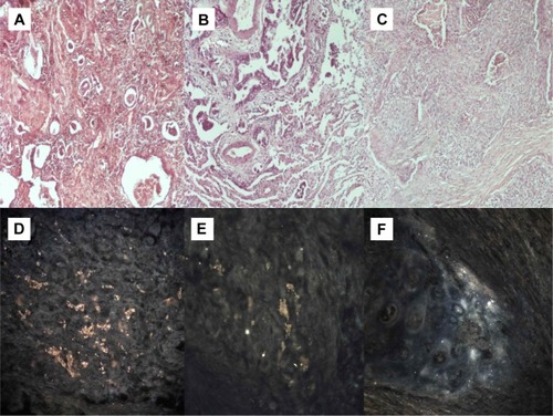 Figure 3 (A) Adenocarcinoma (microscopic observation 100×). (B) Adenocarcinoma with epidermal growth factor receptor mutation (microscopic observation 100×). (C) Squamous cell carcinoma (microscopic observation 100×). CytoViva® spectral imaging of (D) an adenocarcinoma, (E) an adenocarcinoma with epidermal growth factor receptor mutation, and (F) a squamous cell carcinoma. Figure 7 (A) Cryptogenic organizing pneumonia (microscopic observation 100×). (B) Sarcoidosis (microscopic observation 100×). (C) Interstitial pulmonary fibrosis (microscopic observation 100×). CytoViva® spectral imaging of (D) cryptogenic organizing pneumonia, (E) sarcoidosis, and (F) interstitial pulmonary fibrosis.Display full size