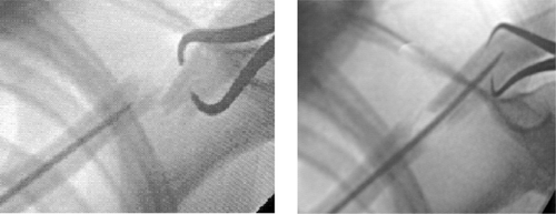 Figure 1. Percutaneous reduction of a displaced midshaft clavicle fracture (left panel) and intraoperative fluoroscopy after guiding the tip of the nail in the outer fragment (right panel).