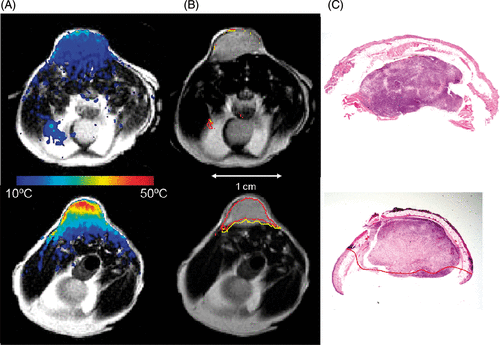 Figure 2. AuNS Mediated Heating – Calculated maximum change in temperature (color) is mapped onto T2-W anatomical images of the mouse xenografts (column a). Relatively low heating is observed in the control (top) versus the highly tumor specific heating observed in the +AuNS tumor (bottom). The cumulative minutes at 43°C (t43) thermal dose was estimated from the temperature history (column b) and the 240 min (red) and 90 min (yellow) isotherms are shown to demonstrate the rapid dose gradient with depth in tissue. H&E staining of tissue post-treatment (column c) demonstrates the correlation between observed damage (red) in the +AuNS versus the expectations from MRTI (columns a&b).