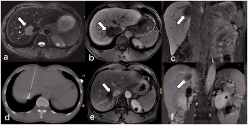 Figure 2. Contrast-enhanced magnetic resonance imaging (MRI) of a 58-year-old male patient diagnosed with a single HCC lesion (3.7 cm × 3.2 cm) adjacent to the second porta hepatis (arrow). The mass showed markedly high signal T2-weighted images (a) and low signal on transverse and coronal MRI in the hepatobiliary phase (b,c). (d) He underwent CT-guided multiple-site MWA in the supine position with the output of 70 W for 20 min in total. A month after the ablation, MRI results (e,f) showed that the lesion was completely necrotic without any enhancement.