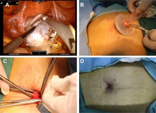 Figure 4 The excision of the specimen and the suture of the surgical incision: (A) The excised cyst was removed into the storage bag. (B) The storage bag was removed via the umbilical incision. (C) The sewed umbilical incision of the patient. (D) The umbilical incision after suture.