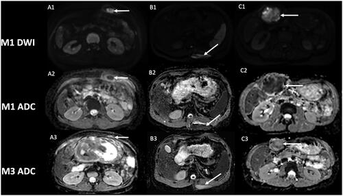 Figure 1. Evolution of diffusion weighted-imaging (DWI) after cryotherapy of extra-abdominal desmoid tumors. Post-cryotherapy imaging of three different patients showing at one-month control a hyperintensity on DWI (A1, B1, C1) with low apparent diffusion coefficient (ADC) within the core of the phantom of the lesion (arrow), and subsequent increase of ADC value at 3-month control (A3, B3, C3). A2: ADC = 0.84 × 10−3 mm2/s; A3: ADC = 1.82 × 10−3 mm2/s.B2: ADC = 0.96 × 10−3 mm2/s; B3: ADC = 2.12 × 10−3 mm2/s.C2: ADC = 0.90 × 10−3 mm2/s; C3: ADC = 1.52 × 10−3 mm2/s.