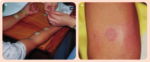 Figure 2. MPB64 skin patch test for active tuberculosis.(A) An aqueous solution containing MPB64 protein is applied to the gauze of the Torii patch, and the patch is then immediately applied to the forearm. After 48–72 h, the patch is removed and the response assessed. (B) A positive patch test result. Image courtesy of Sequella, Inc. (MD, USA) and reproduced with permission.