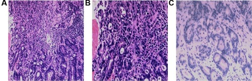 Figure 2 Pathologic findings of the gastroscopy biopsy. (A and B) The high-medium differentiated adenocarcinoma showed that some glands were well structured with obvious cell atypia; some glands were cribriform with cell atypia (hematoxylin and eosin, original magnification from left to right was ×100, ×200). (C) Immunohistochemistry of HER2 demonstrated completely negative staining in tumor cells (immunohistochemistry, original magnification ×200).