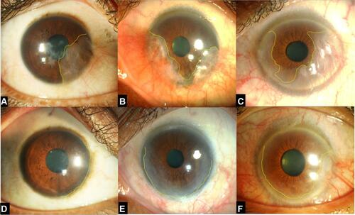 Figure 2 Outcomes of conjunctival autograft (CAG) and simple limbal epithelial transplantation (SLET) in eyes with unilateral partial limbal stem cell deficiency (LSCD). The top row shows preoperative photos of patients with unilateral partial LSCD (A–C). For the first two eyes (A and B), the patient underwent CAG with a successful outcome and no recurrence of LSCD (D and E). For the third eye (C), the patient underwent SLET with recurrence of LSCD in the temporal quadrant (F).