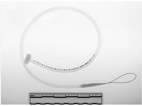 Figure 1. Entake PEG safety system (Commed, Utica, NY). The tube dome is collapsible upon pulling allowing passage of the tube through the gastrocutaneous tract.
