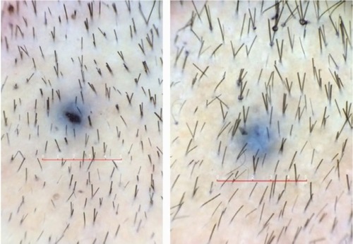 Figure 9 Baseline (left) versus 24-week (right) macrophotograph of the patient in Figure 8.