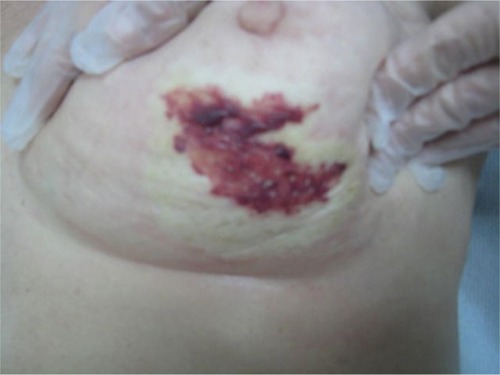 Figure 1 The picture shows the lesion characterized by a big morula and many pustules with a frail roof within hemorrhagic fluid, outlined by an edematous circular edge.