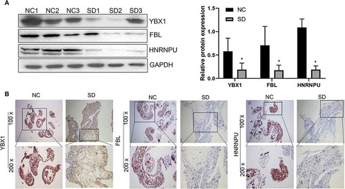 Figure 3. Expression of YBX1, FBL, and HNRNPU in men with normal spermatogenesis (NC) and men with spermatogenic dysfunction (SD) verified by WB (A) and IHC (B). These three proteins – YBX1, FBL, and HNRNPU – were downregulated in the testicular tissue of men from the SD group when compared to men from the NC group. *P < 0.05, 100x, and 200x represent micrograph magnifications of 100 × and 200 ×