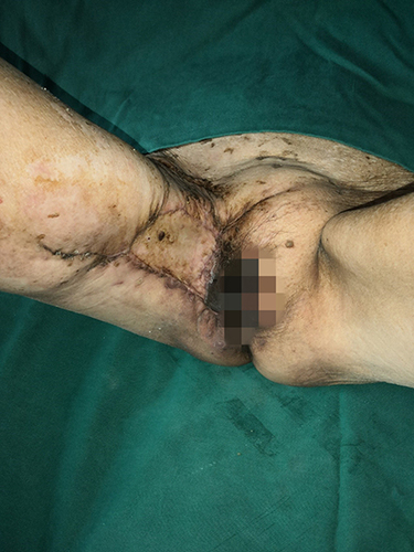 Figure 6 Postoperative Recovery after Skin Grafting and debridement.