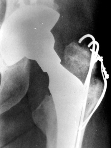 Figure 3C. A 2-year postoperative radiograph showing that the bone graft had incorporated and the fracture had healed.
