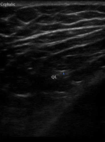 Figure 3 The long-axis views of the middle branch of the SCN. Blue arrow denotes medial branch of the SCN.