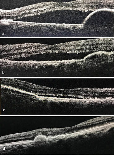 Figure 3 Representative case of a 72-year-old female, with a treatment-naïve PCV eye. (a) Baseline: spectral domain OCT (SD-OCT) image showing SRF, notch like PED; (b) follow-up 1: SD-OCT image at 4 weeks after Brolucizumab injection showing partial resolution of SRF along with significant reduction on PED height; (c) follow-up 2: SD-OCT image at 8 weeks after Brolucizumab injection showing minimal SRF and PED height further reduced; (d) follow-up 3: SD-OCT image at 12 weeks after Brolucizumab injection showing complete resolution of SRF and minimal RPE corrugation and flat macula.
