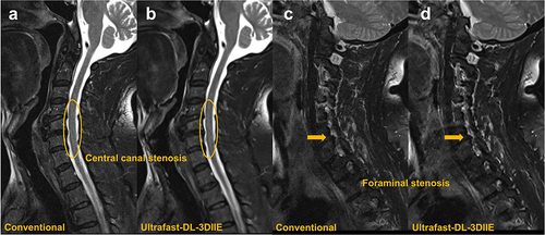 Figure 2 Sagittal T2-weighted images of a participant with central canal stenosis (C3-7 levels, Orange ellipses), were obtained from both conventional (a) and ultrafast-DL-3DIIE (b) protocols. And sagittal T2-weighted images of a participant with foraminal stenosis (C5-6 level, Orange arrows), obtained from both conventional (c) and ultrafast-DL-3DIIE (d) protocols.