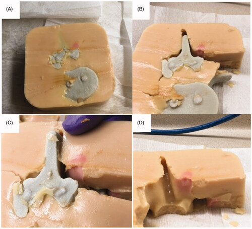 Figure 5. Ablation results of 3D printed tissue-mimicking thermochromic phantom of the lumbar spine. (A) 3D printed spinal segment was embedded in the thermochromic phantom. (B) Dissected cross-section shows red dot indicates ablated area. (C) Separation of the 3D spine model from thermochromic phantom demonstrates depth and color change in desired ablated area. (D) Close up image of dissected phantom demonstrates no evidence of heat deposition in non-targeted areas, including spinal canal and expected areas of the nerve roots.
