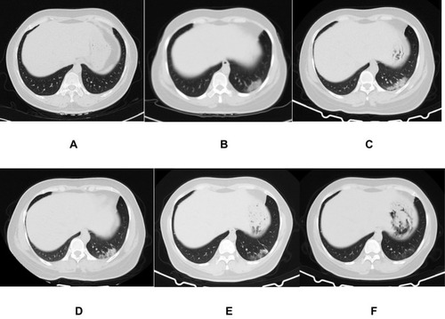 Figure 1 A 45-year-old woman who exposed to COVID-19 patients has cough and diarrhea for 2 days. The initial chest CT is negative (A). After 4 days, the first repeat CT shows a new patch GGO located in the left lower lobe with homogeneous density (B). Subsequently, this new lesion increases in extent and density (C), and then absorbs gradually (D and E). On the latest CT scan (31 days later), it significantly absorbs and leaves a small amount of faint GGO (F).