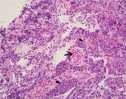 Figure 4 Histopathology features of chronic eosinophilic pneumonia.
