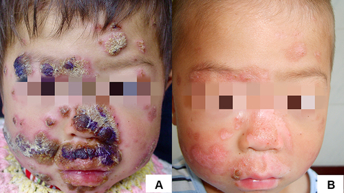 Figure 1 Clinical manifestations of CMC. (A) Facial lesions before treatment, with visible red plaques covered with thick brown scabs. (B) After 1 month of itraconazole treatment, the thick scabs had disappeared, and the plaque area was reduced and flattened.
